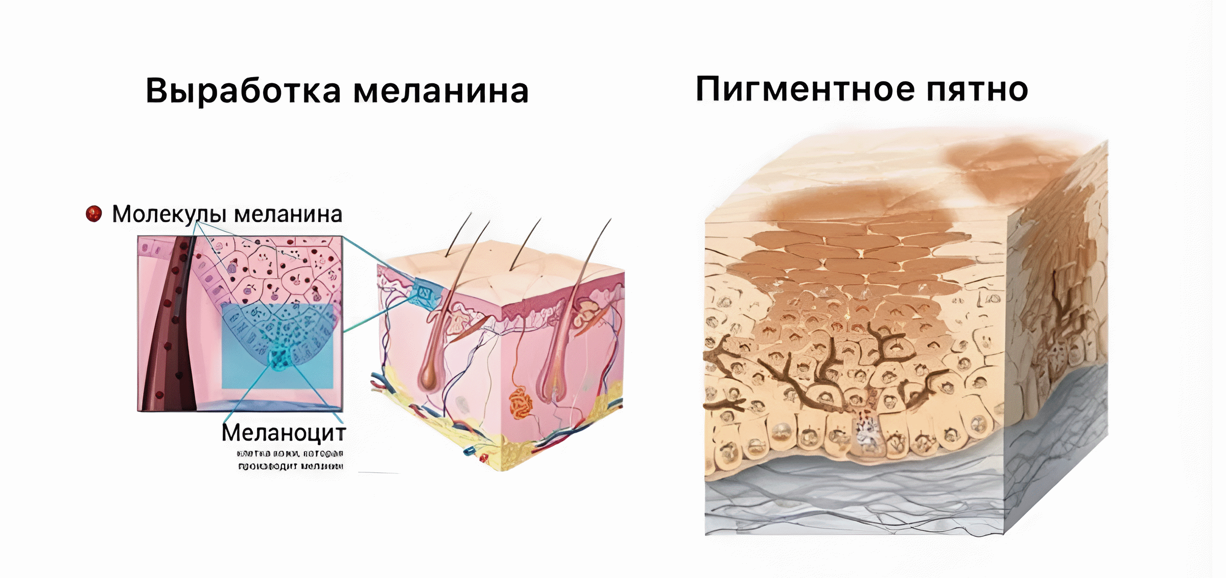 Схема: выработка меланина и пигментное пятно